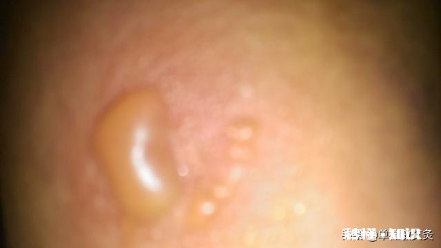 自已在家做膝盖艾灸可是脚脖子红点了怎么回事