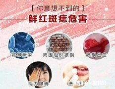 胎记是怎么形成的