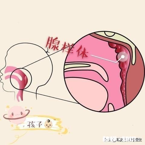 针对孩子的腺样体肥大，你们怎么看