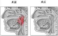 针对孩子的腺样体肥大，你们怎么看