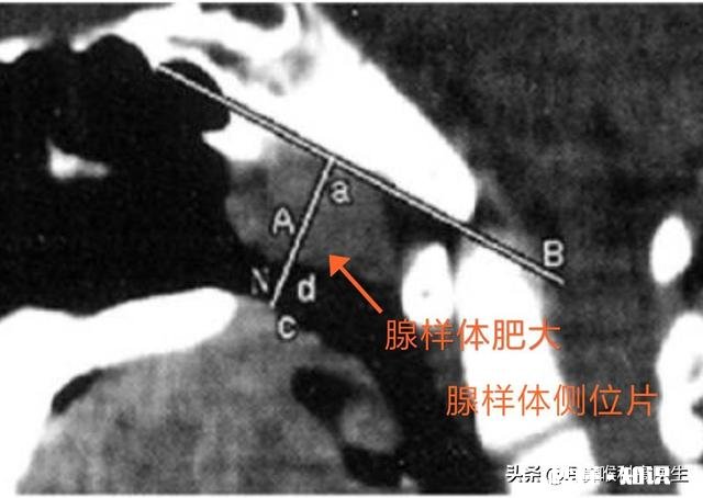 针对孩子的腺样体肥大，你们怎么看