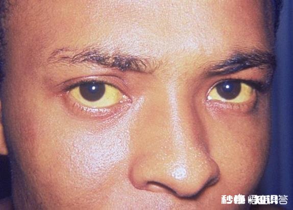 胰腺癌一般哪里会出现疼痛