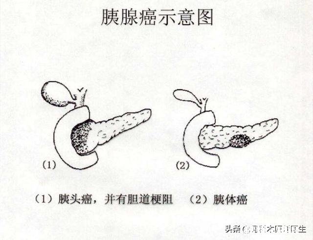 胰腺癌一般哪里会出现疼痛