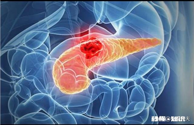 胰腺癌一般哪里会出现疼痛