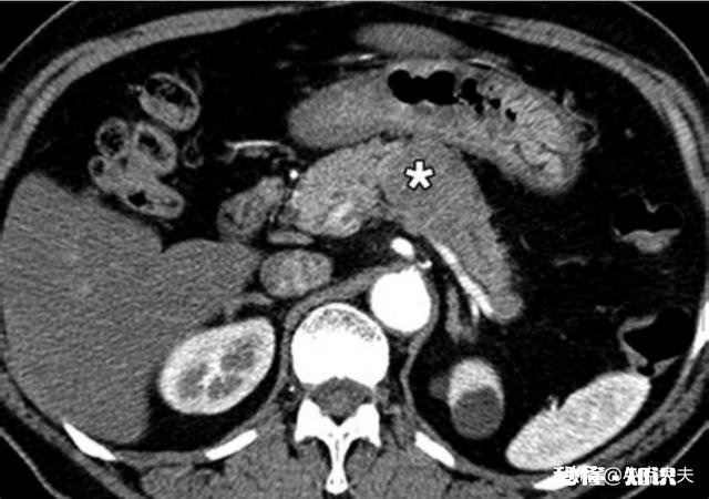 胰腺癌一般哪里会出现疼痛