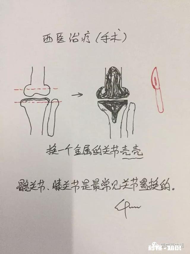 骨关节炎是冻出来的吗应该怎么办