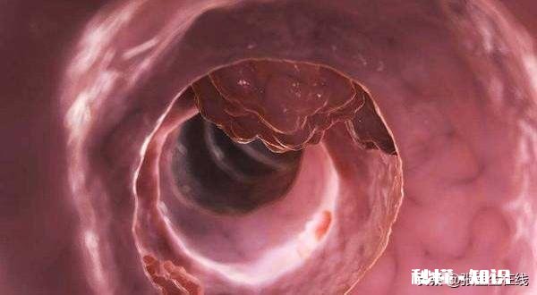 排便时出现哪些异常需要小心