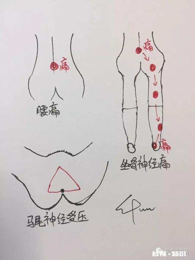 腰椎间盘突出怎么办