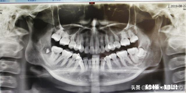 智齿离神经多远