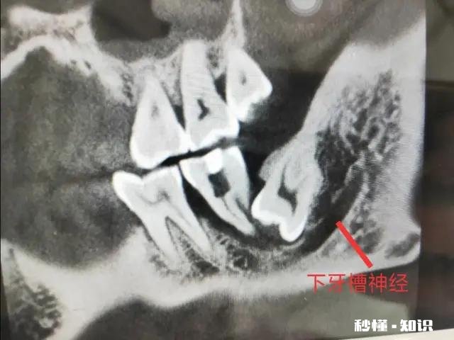 智齿离神经多远
