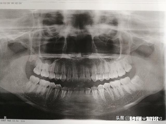 智齿离神经多远