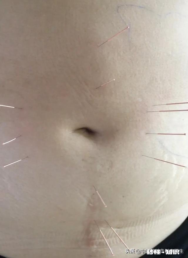 请问腹部针灸是什么感受，会不会疼