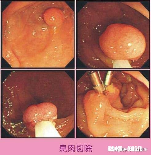 有了肠息肉是不是一定得切除为什么呢