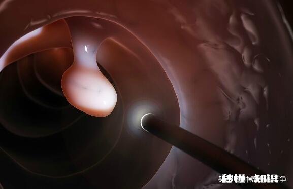 有了肠息肉是不是一定得切除为什么呢