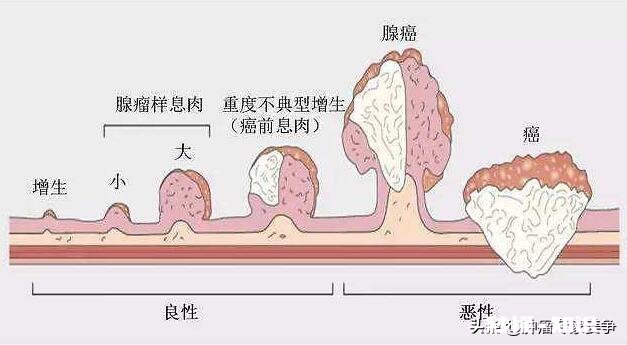 有了肠息肉是不是一定得切除为什么呢
