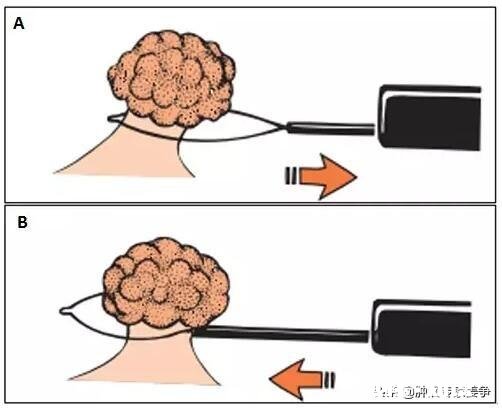 有了肠息肉是不是一定得切除为什么呢