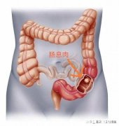 有了肠息肉是不是一定得切除为什么呢