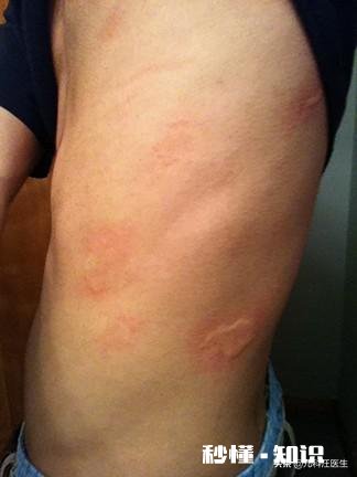 宝宝长荨麻疹,应该怎么处理
