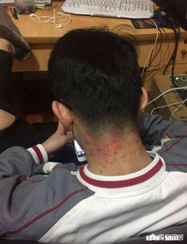 怎么才能控制不抠痘痘