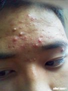 怎么才能控制不抠痘痘