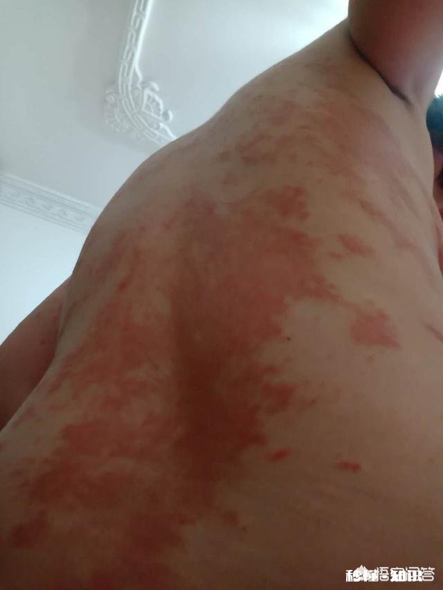 有些人说医院开的祛痘药膏含有激素，最好不要用，所以到底要不要用