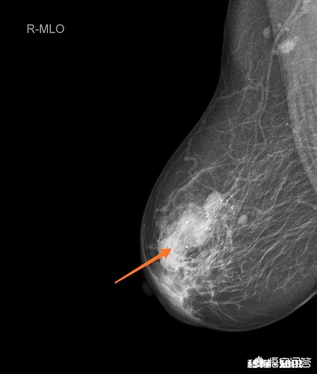 乳房结节钙化是乳腺癌的前兆吗日常生活中应该注意哪些问题