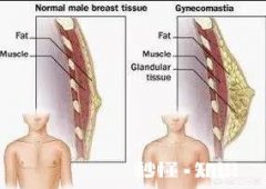 男人乳腺增生吃什么药比较好有哪些需要注意的问题