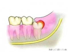 新型肺炎疫情期间得了智齿冠周炎，我该如何撑过这段时间