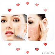 什么样的肌肤属于敏感肌敏感肌有哪些特征