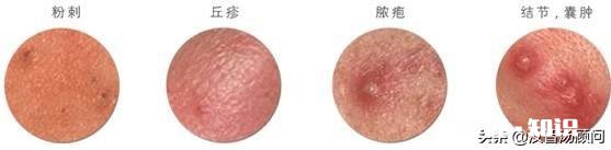 有什么方法可以彻底去除黑头粉刺，好几年了，感觉很多人提的意见都没得用