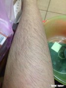 体毛多怎么办
