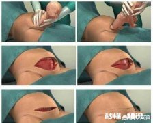 请问：剖腹产从剖肚子到孩子娩出要多长时间