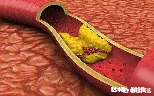 老人血管硬化吃什么