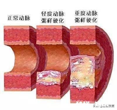 老人血管硬化吃什么