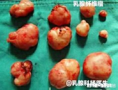 乳腺纤维腺瘤需要做手术吗