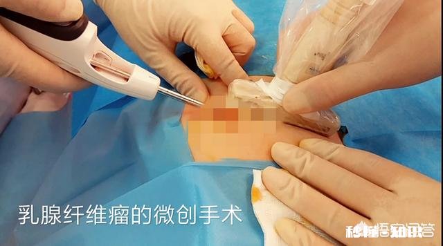 乳腺纤维腺瘤需要做手术吗
