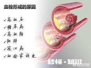 血栓堵在哪里，哪里就发病，怎样减少血栓发生