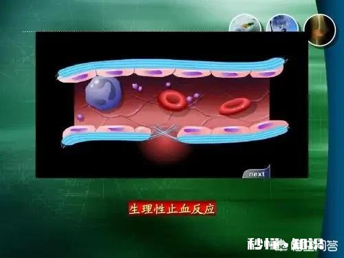 血栓堵在哪里，哪里就发病，怎样减少血栓发生