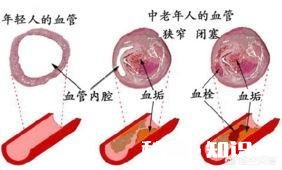 血栓堵在哪里，哪里就发病，怎样减少血栓发生
