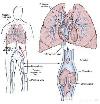 血栓堵在哪里，哪里就发病，怎样减少血栓发生