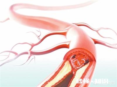 血栓堵在哪里，哪里就发病，怎样减少血栓发生