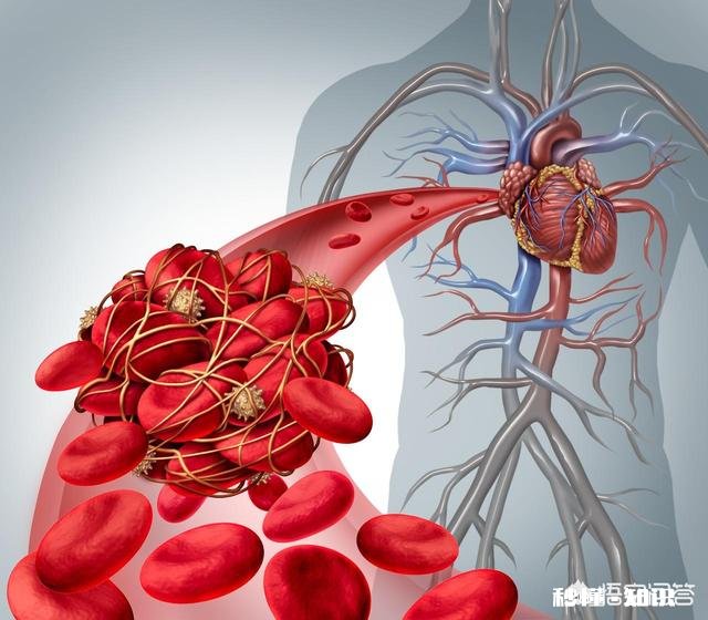 血栓堵在哪里，哪里就发病，怎样减少血栓发生