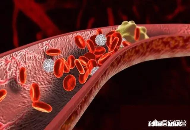 血栓堵在哪里，哪里就发病，怎样减少血栓发生