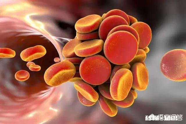 血栓堵在哪里，哪里就发病，怎样减少血栓发生