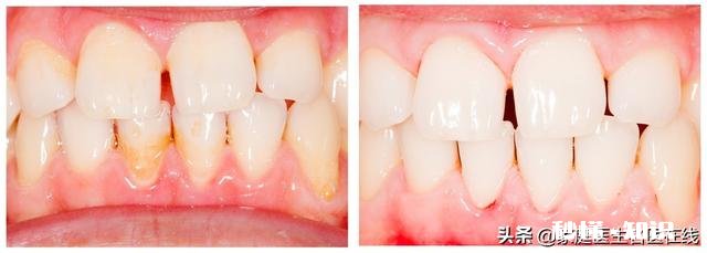 牙缝抠出的“黄泥”是什么东西闻起来臭烘烘贼酸爽