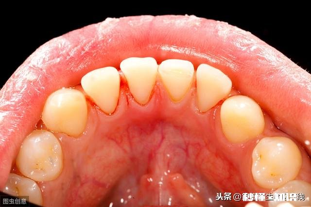 牙缝抠出的“黄泥”是什么东西闻起来臭烘烘贼酸爽