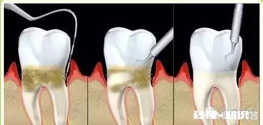 牙缝抠出的“黄泥”是什么东西闻起来臭烘烘贼酸爽