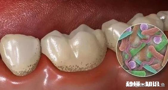 牙缝抠出的“黄泥”是什么东西闻起来臭烘烘贼酸爽