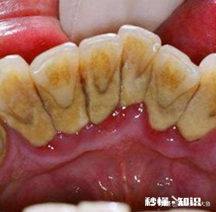 牙缝抠出的“黄泥”是什么东西闻起来臭烘烘贼酸爽