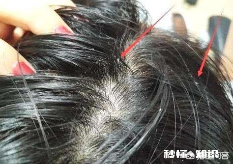 如果头上被螨虫“撕咬、破坏”了，会出现什么严重的问题呢